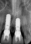 Figure 11 Radiograph of the IPS e.max abutments to verify fit.