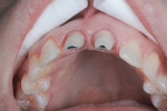Figure 14 Palatal
view demonstrates excellent tissue control.