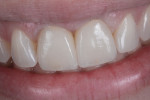 Figure 16 Natural smile view of the patient with the definitive implant supported IPS e.max lithium disilicate restorations.