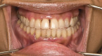 Fig 4 Pre-whitening view of a middle-aged female patient who presented with generalized tooth discoloration. Additionally, the patient showed signs of moderate to severe gingivitis but declined treatment for this condition.