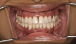 Fig 5 Pre-whitening view of a middle-aged female patient who presented with generalized tooth discoloration. Additionally, the patient showed signs of moderate to severe gingivitis but declined treatment for this condition.
