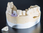 Figure 4. Finished abutment and zirconia crown.