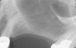 Figure 3  Severe pneumatization of the left maxillary sinus left less than 2 mm of residual bone in the area of teeth Nos. 13 and 14.