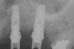 Figure 5  With adequate height of bone, two implants could be placed predictably and with primary stability.