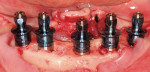 Figure 7  After removal of the mandibular dentition, implants are inserted into the newly edentulous ridge.