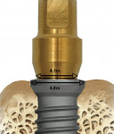 Figure 12  The implant platform is 0.7 mm wider than the abutment that inserts into it, creating a medialized microgap.