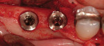 Figure 13  Two platform switch-type implants in position. Note the greater coronal dimension of the platforms (Surgery courtesy of Dr. Harold Baumgarten).