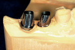 Figure 14  The narrower abutments in place on the model.