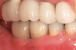 Figure 15  The final implant restorations for teeth Nos. 30 and 31. (Restoration courtesy of Dr. Harold Baumgarten)