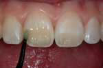 Figure 9  The prepared enamel and dentin was saturated with bonding resin.