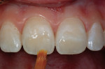 Figure 15  A white composite tint was placed on top of the cured dentin layer and cured before placement of the enamel layer.