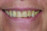 Figure 1 Preoperative smile showing broken, discolored teeth with acceptable gingival levels and incisal edge position of maxillary centrals.