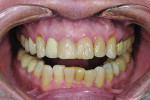 Figure 2 Preoperative gingival recession, lower cross-bite, and recurrent decay under posterior crowns were evident.