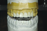 Figure 3 Following occlusal equilibration, a diagnostic wax-up was completed on a semi-adjustable articulator.