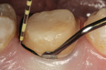 Figure 3a  A primary compression cord of small diameter is placed using a periodontal probe and cord packing instrument to facilitate insertion with low force.