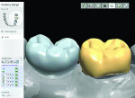 Figure 8 A scan abutment was placed on No. 19, after which teeth Nos. 18 and 19 were designed.