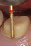Figure 4  The finish line of the preparation is extended to the coronal aspect of the cord, which places the finish line of the final restoration approximately 0.5 mm to 1 mm below the gingiva.