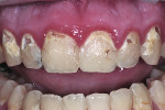 Figure 2 Composite restorations were planned for 16 teeth with the first visit focusing on the maxilla.