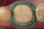 Figure 6a  Gingival retraction is allowed to remain for 5 to 10 minutes to allow water absorption by the superficial cord and increase crevicular width.
