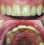 Figure 1 A new patient stated that she
did not like the color of tooth No. 9.