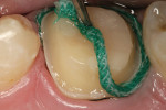 Figure 6b  Excess moisture is eliminated and the second cord is removed.