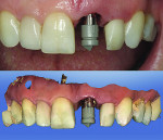Figure 10 After 6 months of healing, a CEREC ScanPost (Sirona Dental, Inc.) was used to image the implant digitally.