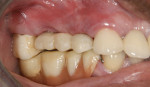 Figure 6 New provisional with undercontoured abutments screwed into place. Note that the pontic had been modified to a flat ridge lap to improve
hygiene access.