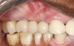 Figure 10 The definitive restoration—a screw-retained porcelainfused-
to-zirconia FPD—in place.
