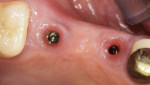 Figure 12 Two weeks post-insertion of the definitive prosthesis, healthy transmucosal adaptation of the gingival collars was exhibited.