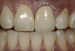 Figure 10  Preoperative view of patient needinggingival esthetic modifications and a newrestoration on tooth No. 9.