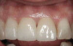 Figure 4 Final restorations shown 2 years after completion. (Restorative dentistry performed by Greggory Kinzer, DDS, Seattle, Washington.)