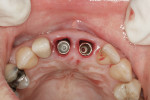 Figure 2 Implants placed, incisal view.