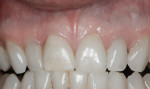 Figure 26 Final view 8 years after treatment. The gingival level and dimensions were stable.