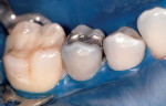 Figure 1  Preoperative photograph of the tooth to be restored. Considerable caries associated with the amalgam dictated restoration with a full crown.