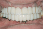 Figure 23 Chairside fabrication of the cement-retained provisional restorations in occlusion
immediately after surgery.