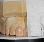 Figure 7. By setting the platform on the articulator, the dental technician can wax first the maxillary incisors and cuspid to the appropriate length, and then wax the posterior teeth to level the occlusal plane where possible.
