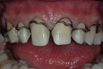 Figure 5  The #1 cord is teased out of the gingival sulcus and the quality of the retraction is evaluated.