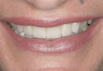 Figure 15. Smile view of completed restorations.