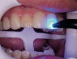 Figure 7  LUMINEERS placed on the 8 teeth and tack cured with 2 mm Sapphire tip.