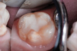 Figure 14 The repaired molar at 34 months
postoperatively.