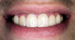 Figure 16  Postoperative smile with noninvasive LUMINEERS.