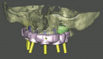 Figure 1  SimPlant® by Materialise Dental is a CT-based implant treatment planningsoftware system that will revolutionize any implant practice.