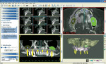 Figure 2  SimPlant® by Materialise Dental is a CT-based implant treatment planningsoftware system that will revolutionize any implant practice.