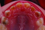 Figure 1 A 3-year-old girl with many severe caries lesions.
