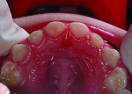 Figure 2 At 26 months after restoration of carious teeth with resin-modified glass-ionomer filling material.