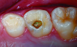 Figure 5 Primary second molar with deep caries lesion.