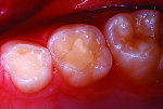 Figure 7 Restored tooth, 2 years after treatment.