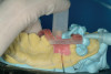 Figure 11: Printed dental model using VeroDentPlusTM material.