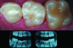 Figure 8 Two primary molars, 5 years after restoration with nano-ionomer material (Ketac™ Nano, 3M ESPE, www.3mespe.com). Bitewing films at 5 years.