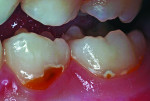 Figure 9 A 5-year-old boy with Class V caries lesions.